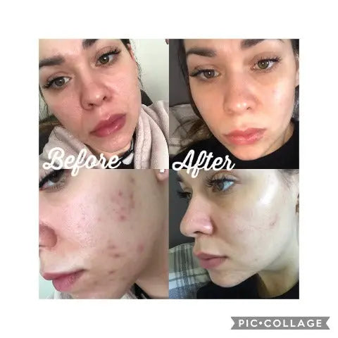 Salicylic Acid 2 Peel Bravuralondon